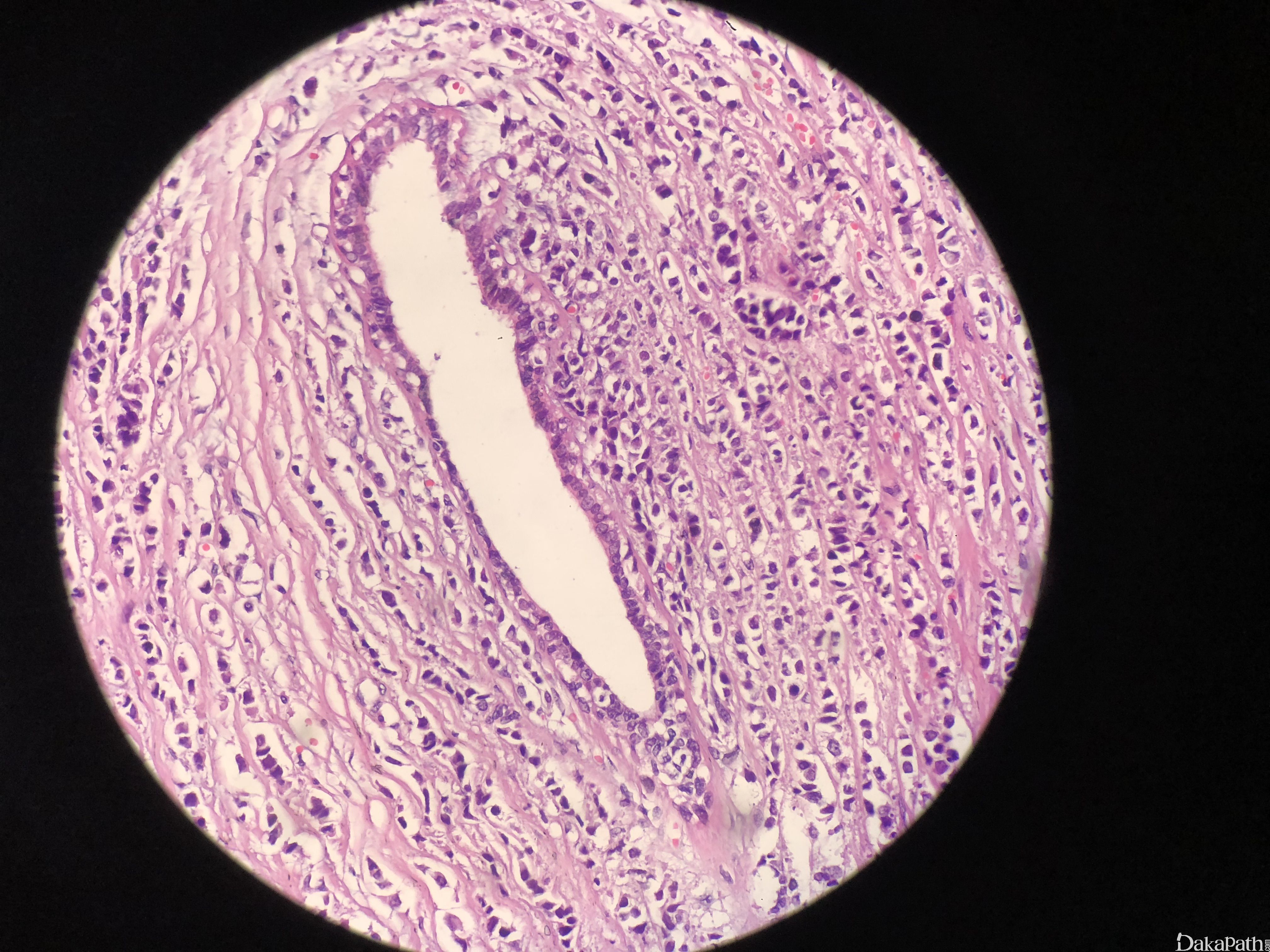 浸润性小叶癌.jpg 浸润性小叶癌.jpg