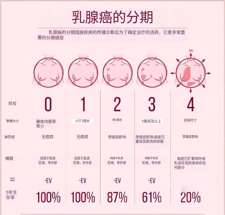 乳腺癌分期.jpg