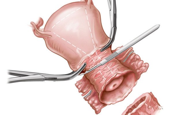 Diagram showcasing how during radical trachelectomy a surgeon removes the cervix and some of the pelvic lymph nodes.