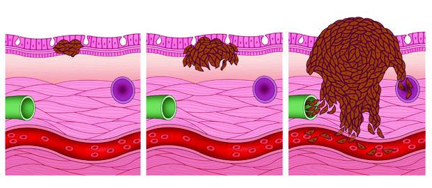 1689671284355652.jpg 肉瘤.jpg