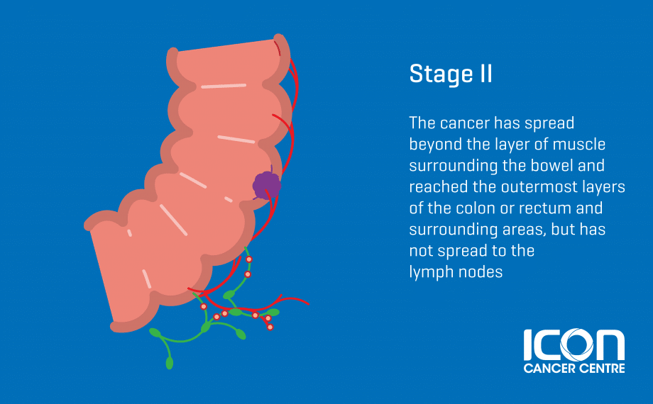 Bowel-Cancer-Stage-2_Singapore-920x570.png