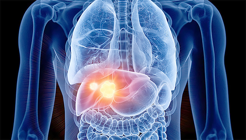 肝癌风险因素、症状及预防 | 圣约翰癌症研究所