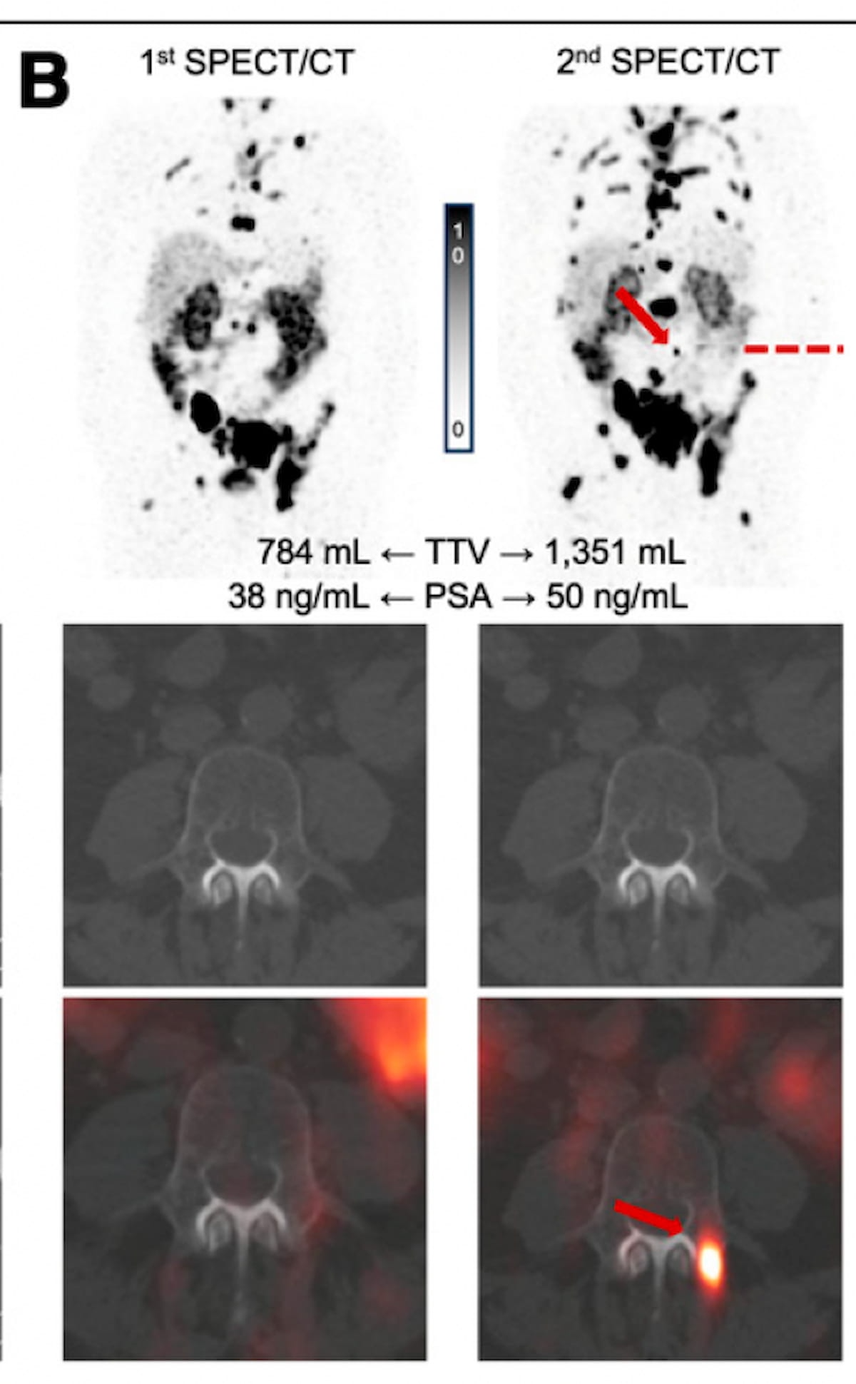 What SPECT/CT May Reveal About Early Treatment Response for Pluvicto in  Patients with mCRPC | Diagnostic Imaging