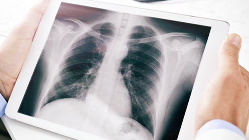 美国看病咨询：肺部磨玻璃结节会转变为肺癌吗？其处理难点何在？是否比实性结节更加危险？