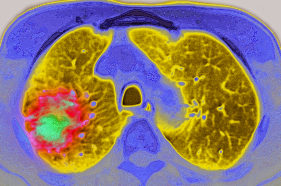 美国治疗肺癌2024免疫疗法迎来重大进展：Tarlatamab加速批准