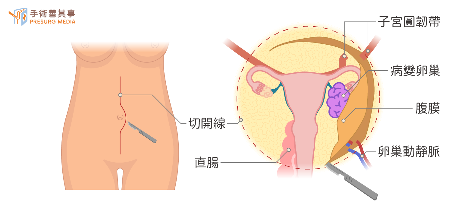 安德森治疗卵巢癌2023最新研究：联合疗法控瘤效果显著