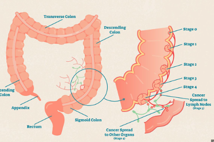 结肠癌出国就医：2024推荐机构，费用和流程 