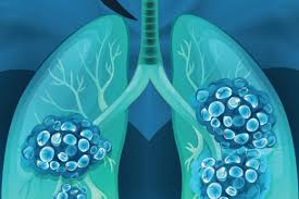 58 岁晚期肺癌患者赴美安德森癌症中心