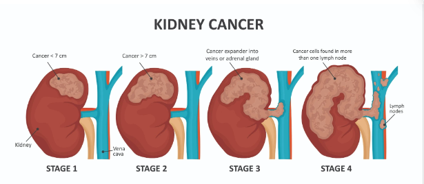 美国治疗肾癌2023：三药组合可减缓晚期肾癌的进展