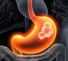 胃癌的危险因素、预防与诊断分期