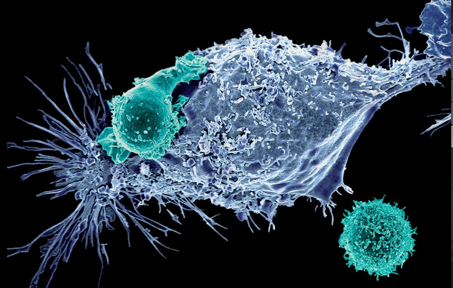 晚期胃癌的新治疗办法：CAR T细胞疗法带来的新希望