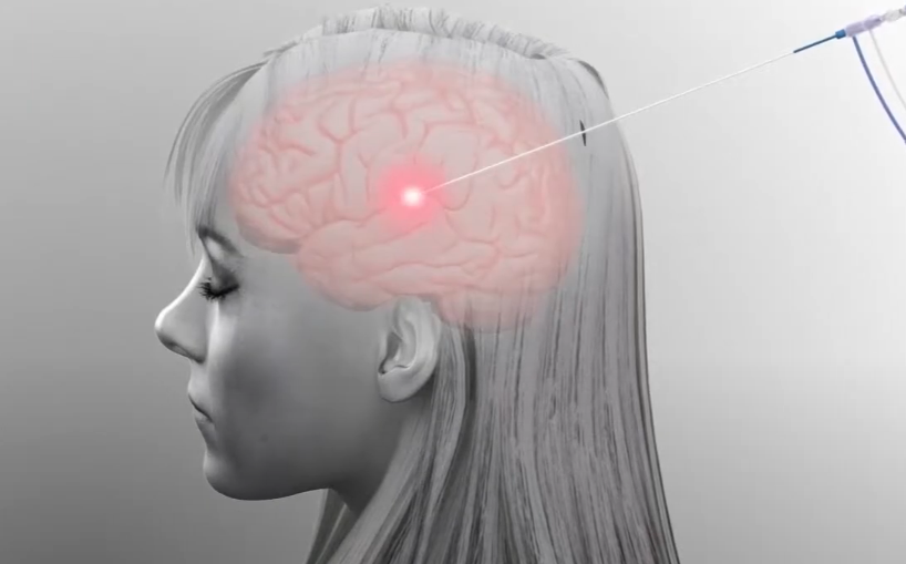 美国难治性癫痫治愈案例，国外如何治疗难治性癫痫