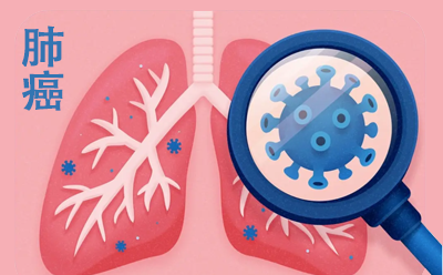 去美国看病：什么是 ALK 阳性肺癌？