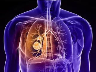 出国看病  盘点美国最新肺癌临床试验