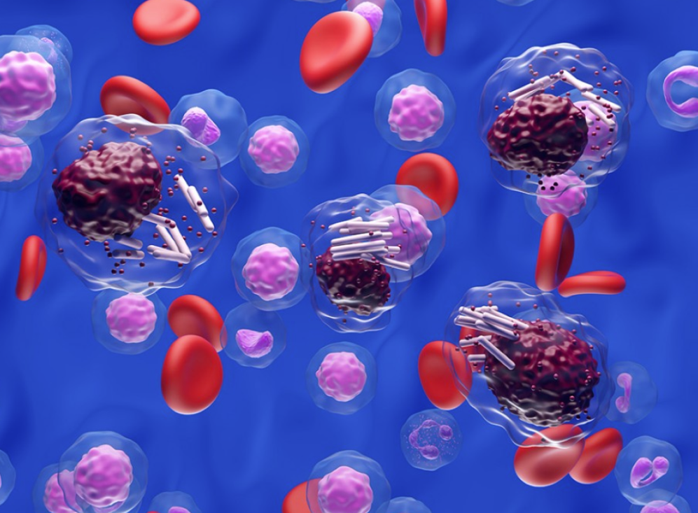 MD安德森治疗白血病：三联疗法超80%反应率，显著延长生存期