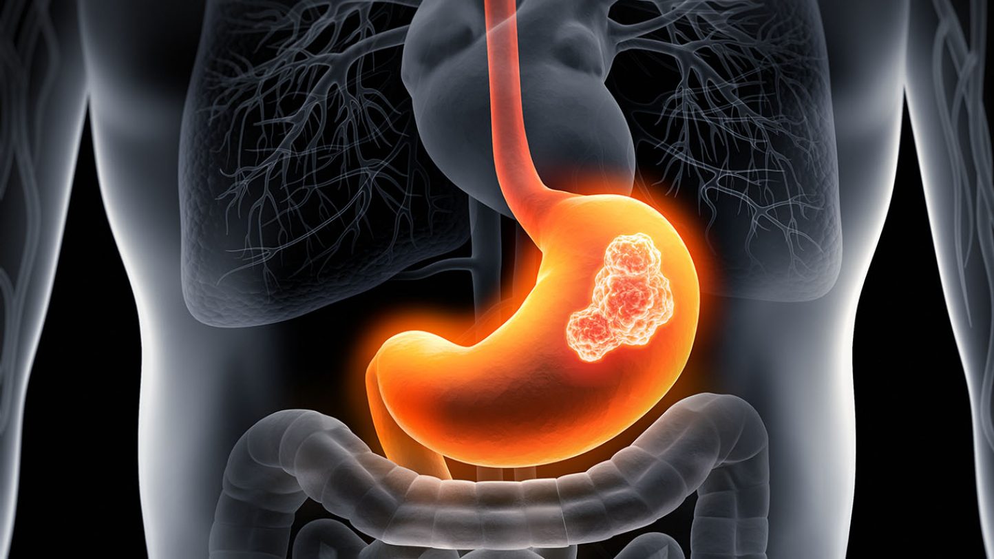 MD安德森癌症中心：2023胃癌治疗发现SDC2新靶点