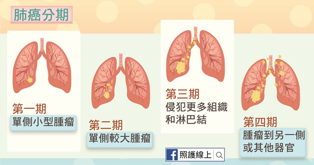 美国治疗肺癌，2023联合免疫疗法优于单独使用 durvalumab