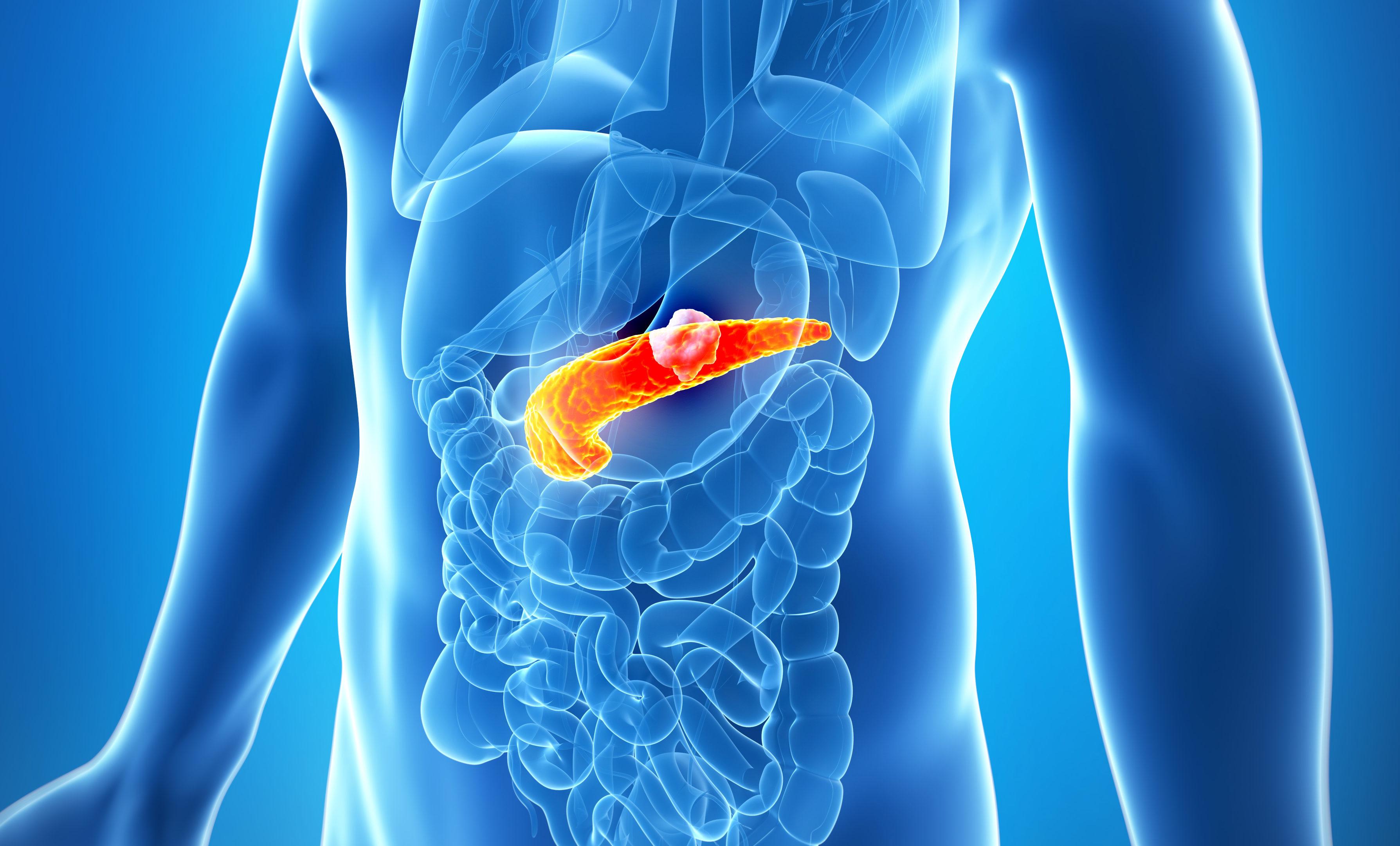 出国治疗胰腺癌的费用分析以及如何申请2024