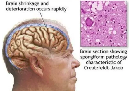克雅氏病-CJD-美国会诊案例