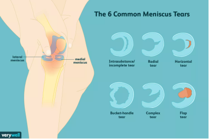 半月板撕裂的国外最新疗法2023-2024