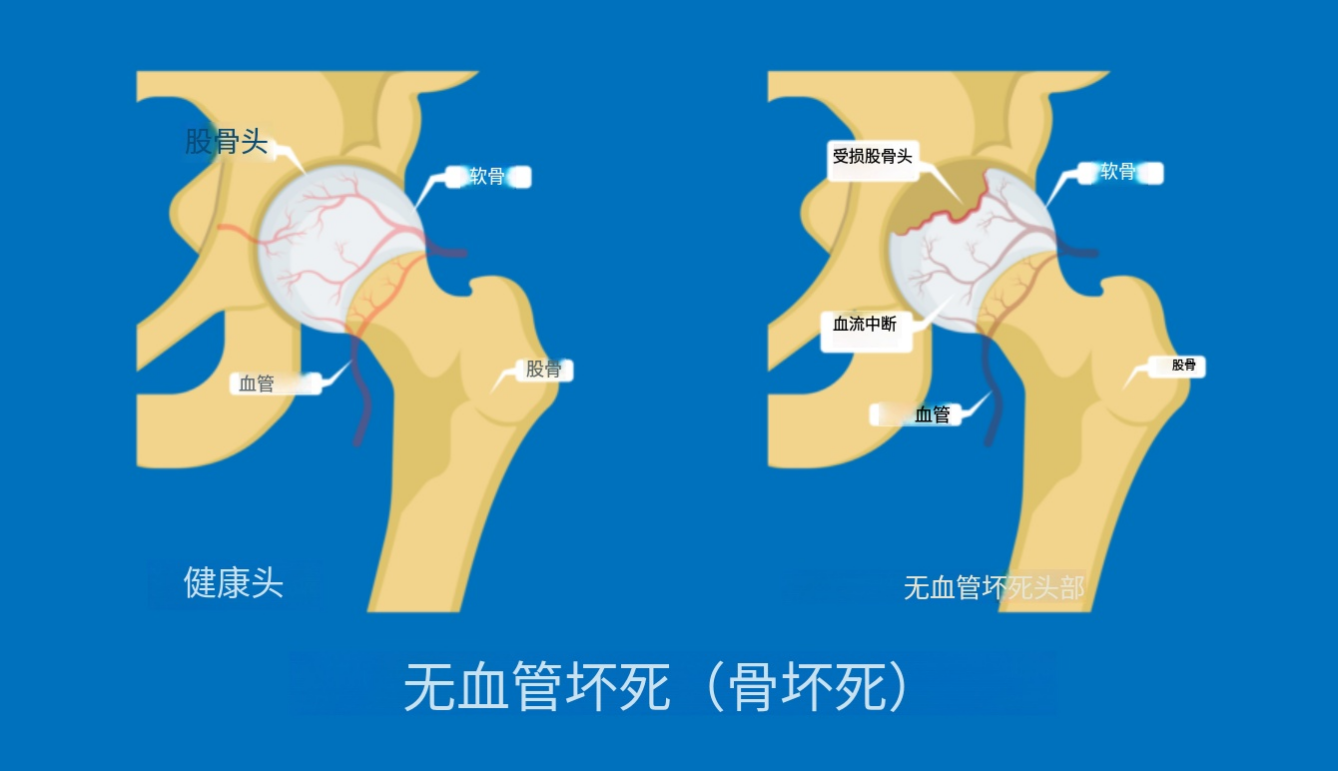 2026美国治疗股骨头坏死：保髋成功率提升至78%的新疗法解析