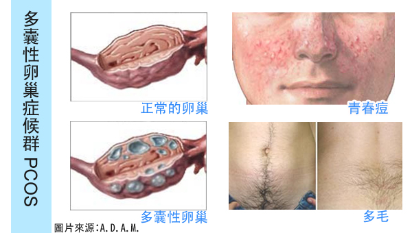 出国看病  美国看病新发现：梅奥诊所分享多囊卵巢综合征治疗方法