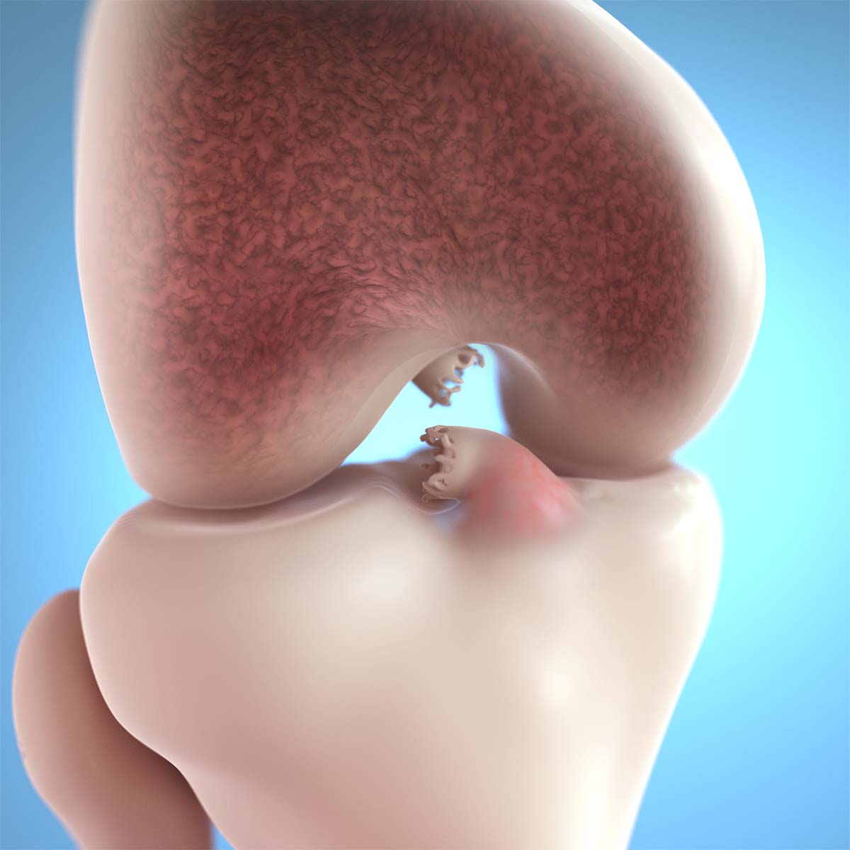 ACL患者获美国第一骨科医院（纽约特种外科医院）专家治愈方案