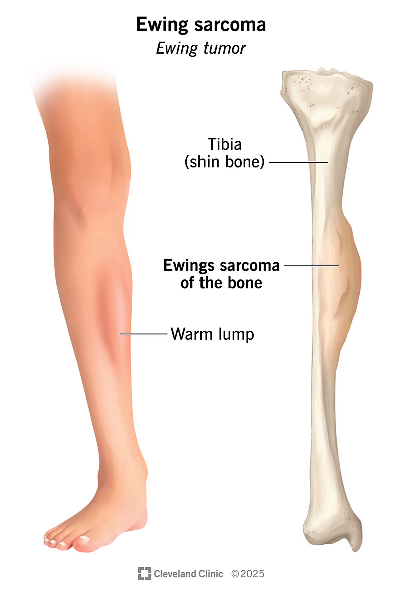 尤文肉瘤美国治疗2026：传统化疗失败后的新窗口