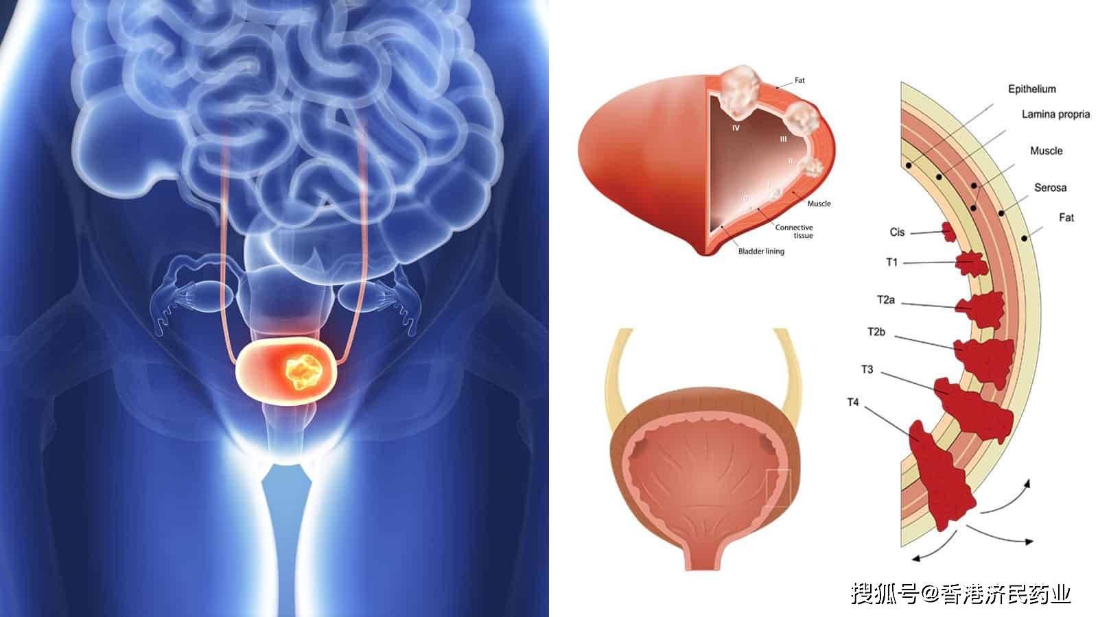出国看病：2022最新美国膀胱癌治疗指南--附中美差异