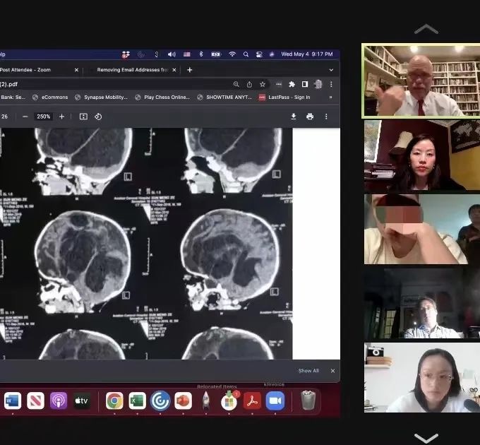 哈佛大学权威癫痫教授会诊：国外治疗中国小儿癫痫案例 