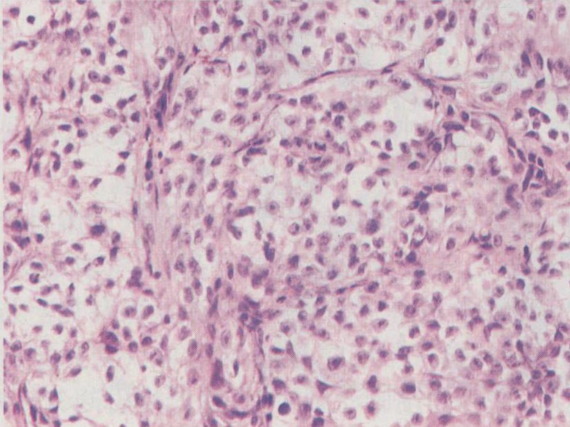 出国治疗肉瘤中介服务—专业咨询与指导