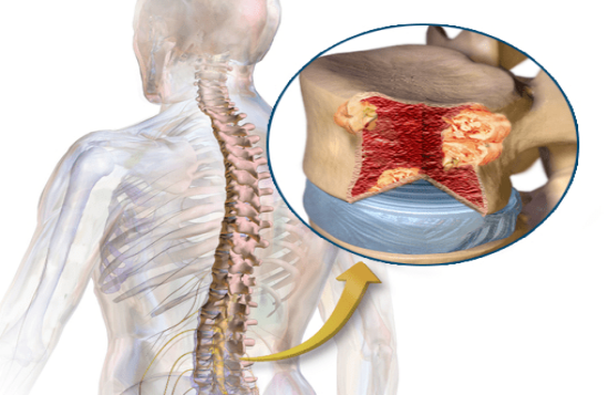 骨髓瘤美国能治愈吗？美国治疗优势和知名医院预约流程