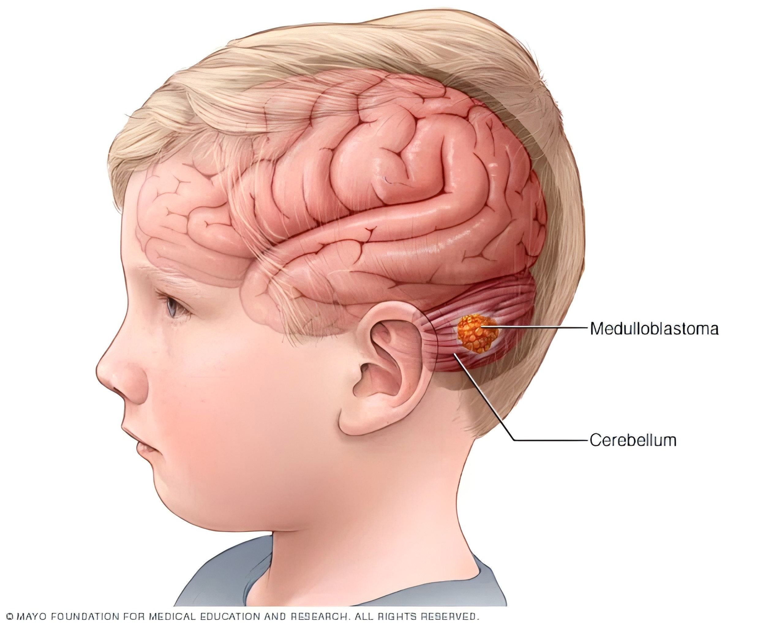 美国治疗晚期髓母细胞瘤效果如何？2026最新生存率达70%？