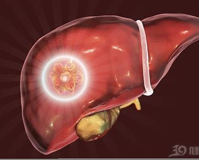 出国看病   美国最好的肝癌医院排名 | 治疗费用和案例