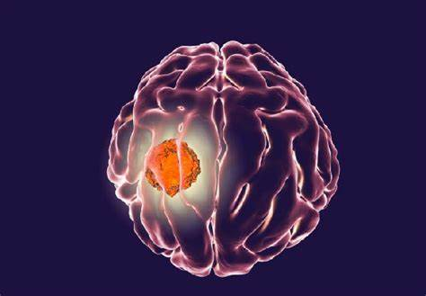 脑胶质瘤出国就医：2024推荐机构，费用和流程