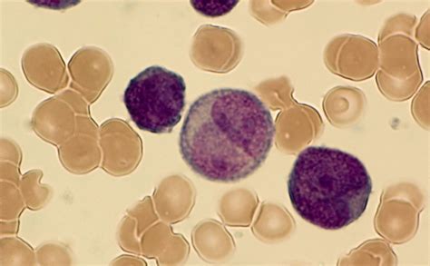 出国看病   美国最好的白血病医院排名 | 世界治疗癌症最权威医院盘点