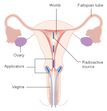 美国癌症中心治疗宫颈癌的多重武器：化疗、靶向治疗和免疫疗法
