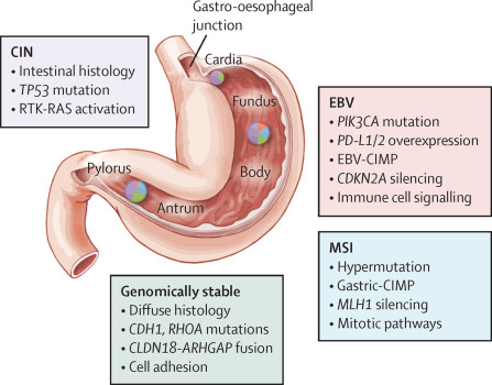 美国治疗胃癌多少钱（包含手术、化疗、放疗等具体金额及2024胃癌新疗法）