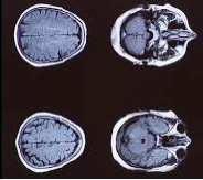 海外看病：癫痫治疗的2024年新趋势，和最有前途的治疗策略