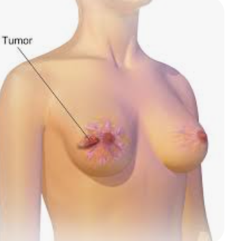 三阴乳腺癌第二年复发，我的这个突变获得美国专家专属方案