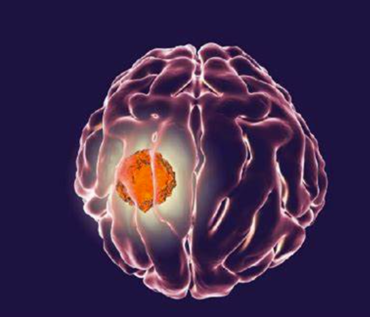 海外看病：出国治疗脑胶质瘤