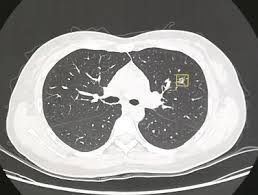 出国看病检查肺磨玻璃结节是什么？常见吗？可能病因有哪些？
