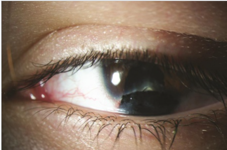 出国看病资讯：眼球染色和眼球“纹身”之深度分析