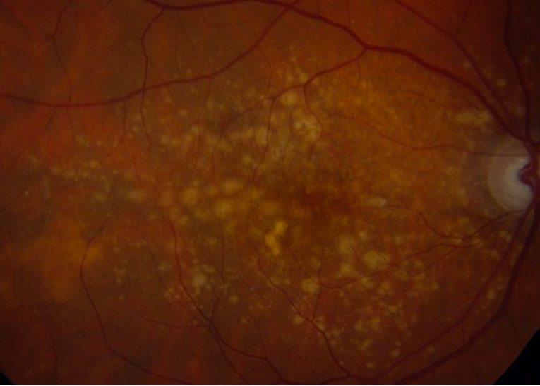 出国看病：眼部疾病黄斑变性前沿疗法2024-2025