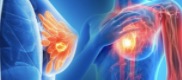美国最好的乳腺癌医院 | 出国就医案例:附中美乳腺癌治疗差异