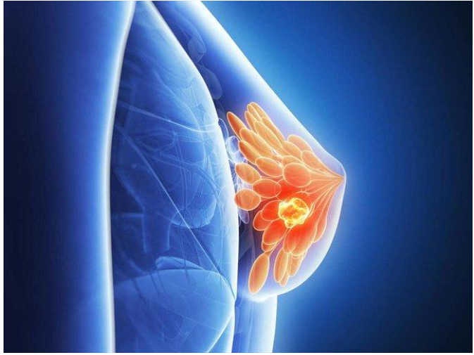 出国就医之安德森关于炎性乳腺癌：您需要了解的 14 件事