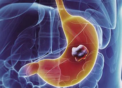 出国看病   美国最好的胃癌医院排名 | 世界治疗癌症最权威医院盘点