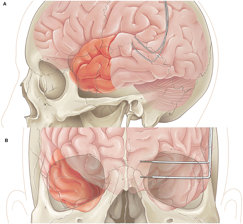 多灶性难治性癫痫国外成功治疗案例